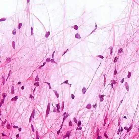 cerebellar astrocytoma